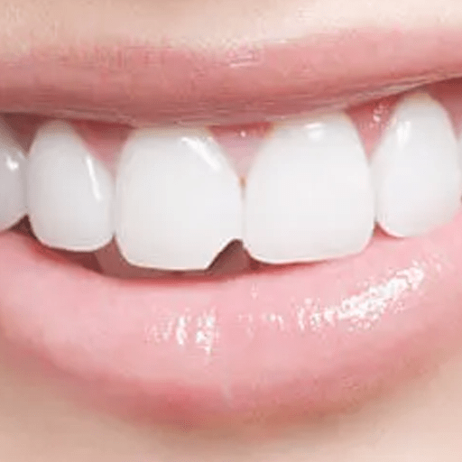 Chipped teeth can be annoying, and at Envisage Dental, we have just the tools to get that tooth looking as good as new! Our dentists are specially trained in cosmetic dentistry to ensure that your chipped tooth gets restored to its original look.